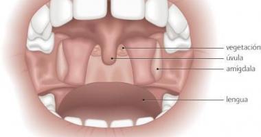 En que consiste la operacion de sinusitis